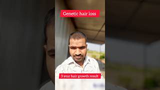 3 Years Minoxidil hair growth results 🔥shorts hairstyle hair [upl. by Yelnats]