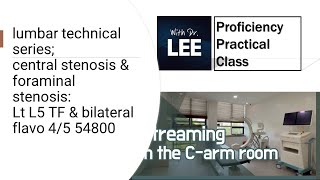 Transforaminal injection technical series part 6 Lt L5 TF amp bilateral flavo 45 54800 [upl. by Palua]