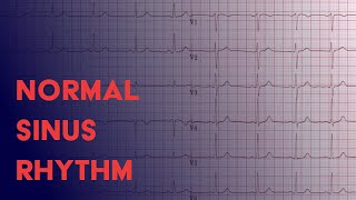 Normal Sinus Rhythm  EKG ECG Interpretation [upl. by Saxe]