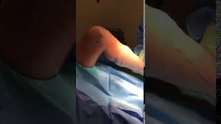 Knee Motion Before Arthroscopic Removal of Arthrofibrosis [upl. by Campy]