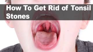 Removing Tonsil Stones [upl. by Noreik]