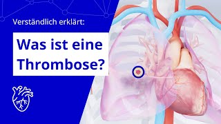 Verständlich erklärt Was ist eine Thrombose [upl. by Novonod]