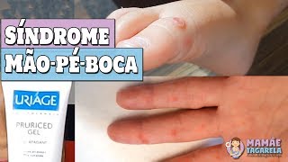 Síndrome Mãopéboca  TUDO que você precisa saber [upl. by Yak839]