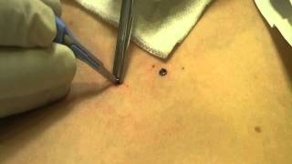 Microdermal Dermal Anchor Removal at MediZen Cosmetic Clinic Birmingham UK [upl. by Claudianus]