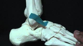 Ankle Sprain ATFL amp Fibula [upl. by Gould]