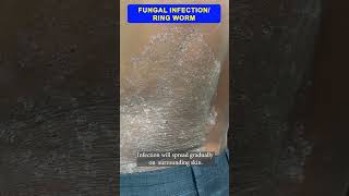 Fungal infection  By Dr Uttam Kumar Lenka MBBS MD Consultant Dermatologist [upl. by Emse]