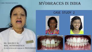 Myobrace case presentation 2 [upl. by Carlick]