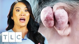 Dr Lee Removes 14 Oz Keloid From Womans Ear  Dr Pimple Popper [upl. by Anette]