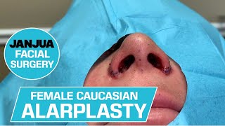 FEMALE CAUCASIAN ALARPLASTY FROM NEW JERSEY  DR TANVEER JANJUA  NEW JERSEY [upl. by Aitram]