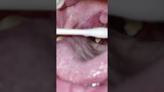 Tonsil stones 58 [upl. by Ysset]