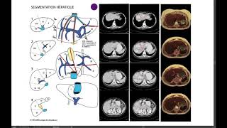 15 5 SEGMENTATION HÉPATIQUE SCANNER [upl. by Ellenar749]