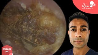 1197  Extreme Ear Wax BuildUp Removal [upl. by Silverman]