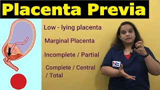 Placenta Previa  APH  Antepartum HemorrhageTypes Risk factors Signs Symptoms  Nursing Lecture [upl. by Branscum]