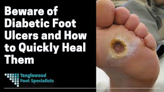 Beware of Diabetic Foot Ulcers and How to Quickly Heal Them [upl. by Mitinger]