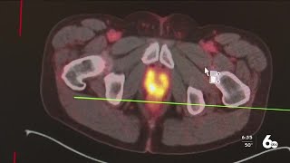 Wellness Wednesday PSMA Pet Scan screening for spreading Prostate Cancer cells [upl. by Ebeohp]