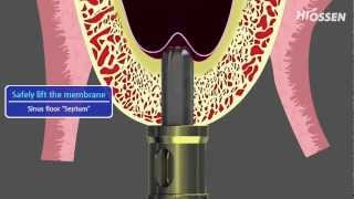 OSSTEM  HIOSSEN CASKit Crestal Approach Sinus Kit [upl. by Oramug238]