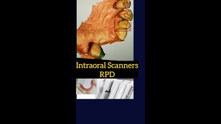 Intraoral Scanner for Removable Partial Denture [upl. by Galvin]