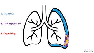 lights criteria pleural effusion [upl. by Iliam]