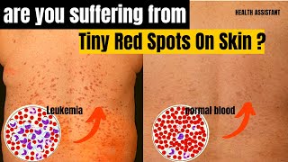 Symptoms Of Leukemia  Leukemia Tiny Red Spots On Skin  Chronic Myeloid Leukemia Symptoms [upl. by Nahte753]