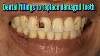 Dental fillings to replace damaged teeth [upl. by Vadim]