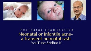 A brief review of Infantile acne Dr Sridhar K [upl. by Snell]