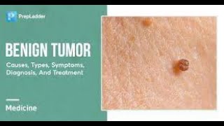 Benign Tumor Symptoms and Causes  Diagnosis  Treatment  Prevention [upl. by Keg27]