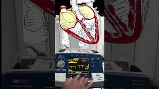 Atrial Fibrillation Cardioversion Video and Animation 🫀🔌 medical cardiology [upl. by Lesiram]