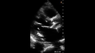 Aortic Stenosis – Ultrasound Image Interpretation [upl. by Ronald]