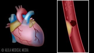 Myocardial Infarction and Coronary Angioplasty Treatment Animation [upl. by Dola939]