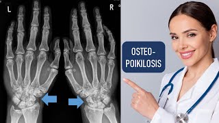 Osteopoikilosis  Sclerosing Bony Dysplasia [upl. by Edithe]