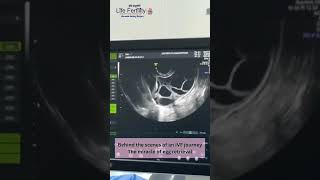 collecting mature eggs from your ovaries lifefertility  viralvideos  doctor  ivf  baby [upl. by Nivra242]