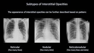 How to Interpret a Chest XRay Lesson 7  Diffuse Lung Processes [upl. by Notecnirp]