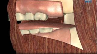 How Myobrace Works What are the causes of crooked teeth Myobrace [upl. by Salim]