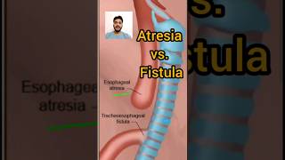 Esophageal atresia vs fistula shorts viral [upl. by Tekcirk]