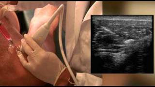 Prolotherapy of the shoulder by Dr Harry Adelson [upl. by Bust712]