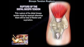 Distal Biceps Tendon Rupture  Everything You Need To Know  Dr Nabil Ebraheim [upl. by Anilag466]