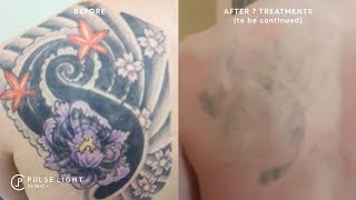 Laser Tattoo Removal  Real People True Results 2023 [upl. by Lovel]