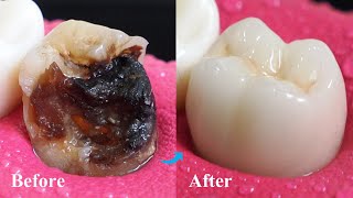 Incredible Restoration Of Tooth By Root Canal And Zirconia Crown [upl. by Alberic]