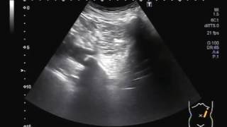 Ultrasound Video showing multiple large stones in the ureter [upl. by Marmion]