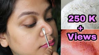 HOW TO REMOVE BLACKHEADS INSTANTLY amp PERMANENTLY  PAINLESS HOME REMEDY [upl. by Erroll554]