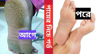 Pitted Keratolysis Treatment পায়ের তলায় ছোট ছোট গর্ত কেন হয়চিকিৎসা কি [upl. by Thordis410]