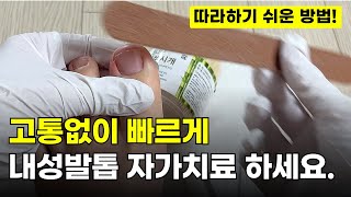 5만명이 찾아 본 내성발톱 자가치료 집에서 따라만 하세요 ㅣ 내성발톱 교정기 제품 추천 [upl. by Derman]