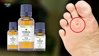 How To Get Rid Of Warts Fast with Healing Natural Oils HWarts Formula [upl. by Ecnahs]