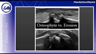 Osteophyte vs Erosion on MSK Ultrasound [upl. by Ardek394]