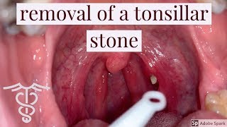 Removal of a tonsillar stone  patient education video by Dr Carlo Oller [upl. by Oicnevuj]