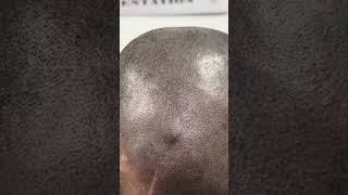 Scalp micro pigmentation in srilnaka [upl. by Letsyrc]