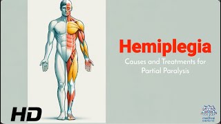 Hemiplegia 101 Identifying Causes and Exploring Effective Therapies [upl. by Crofoot]