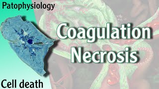 Pathophysiology  Coagulation Necrosis Hani Laith شرح [upl. by Tutankhamen]