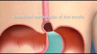 Barretts Esophagus Intestinal Metaplasia of the CardiaMayo Clinic [upl. by Nairolf]