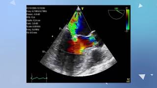 Mitral Valve Anatomy Review  Transesophageal Echocardiogram [upl. by Ayram]